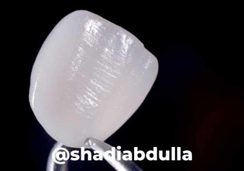 lentes-de-contato-dentais-shadi-abdulla